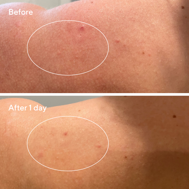 Murad Retexturizing Body & Face Pads για ακμή και κερατόρροια pilaris